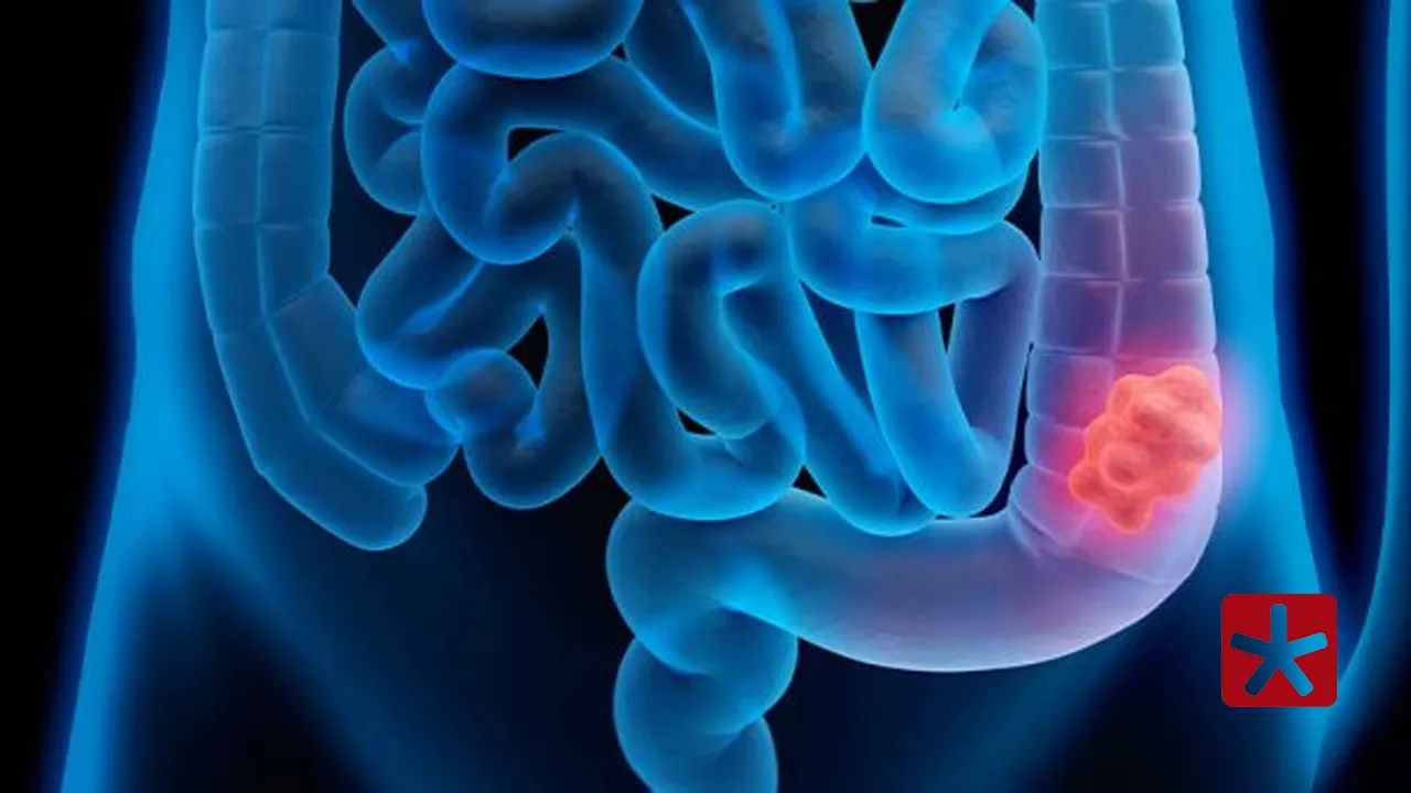 Câncer colorretal: doença é o terceiro tipo que mais mata no país e o segundo mais comum